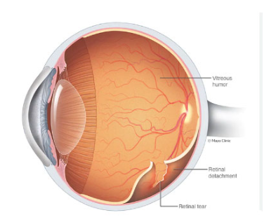 Retinal Detachment