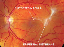 Epiretinal Membrane