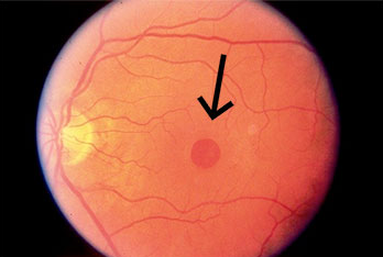 Macular Hole