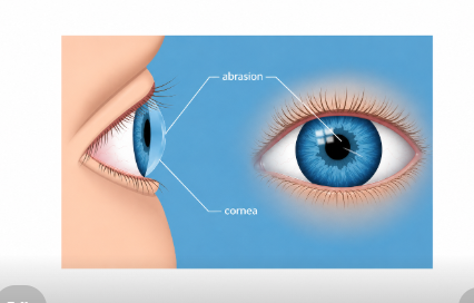 Cornea Treatment