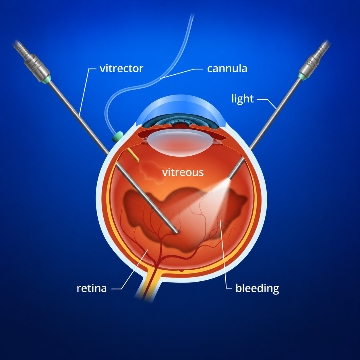 Vitrectomy Surgery