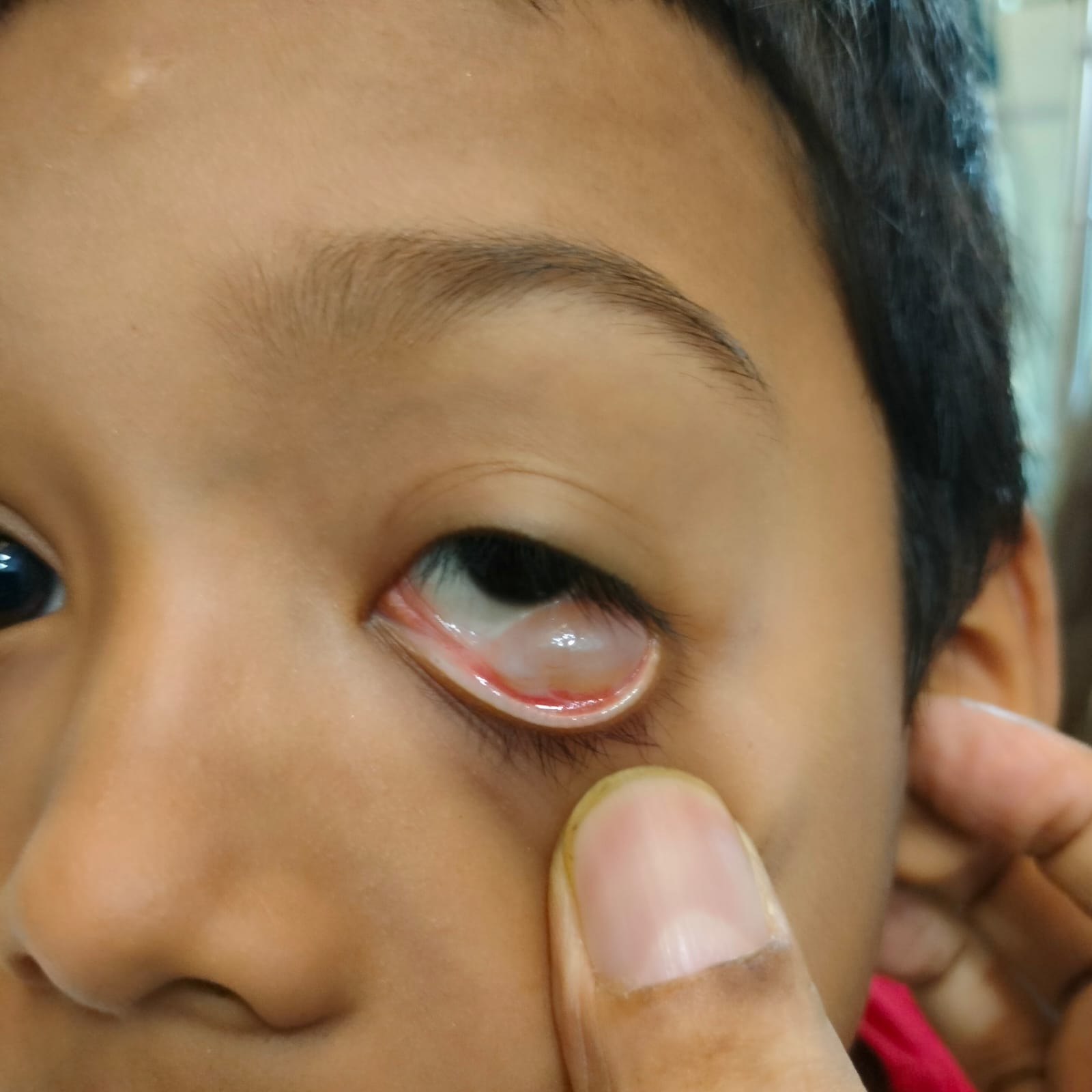 From Eye Irritation to Relief: A Successful Conjunctival Cyst Treatment