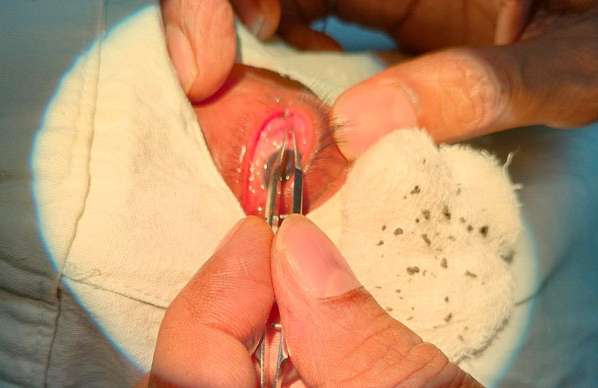 Successfully removed multiple minute stone particles from the eye of a construction worker