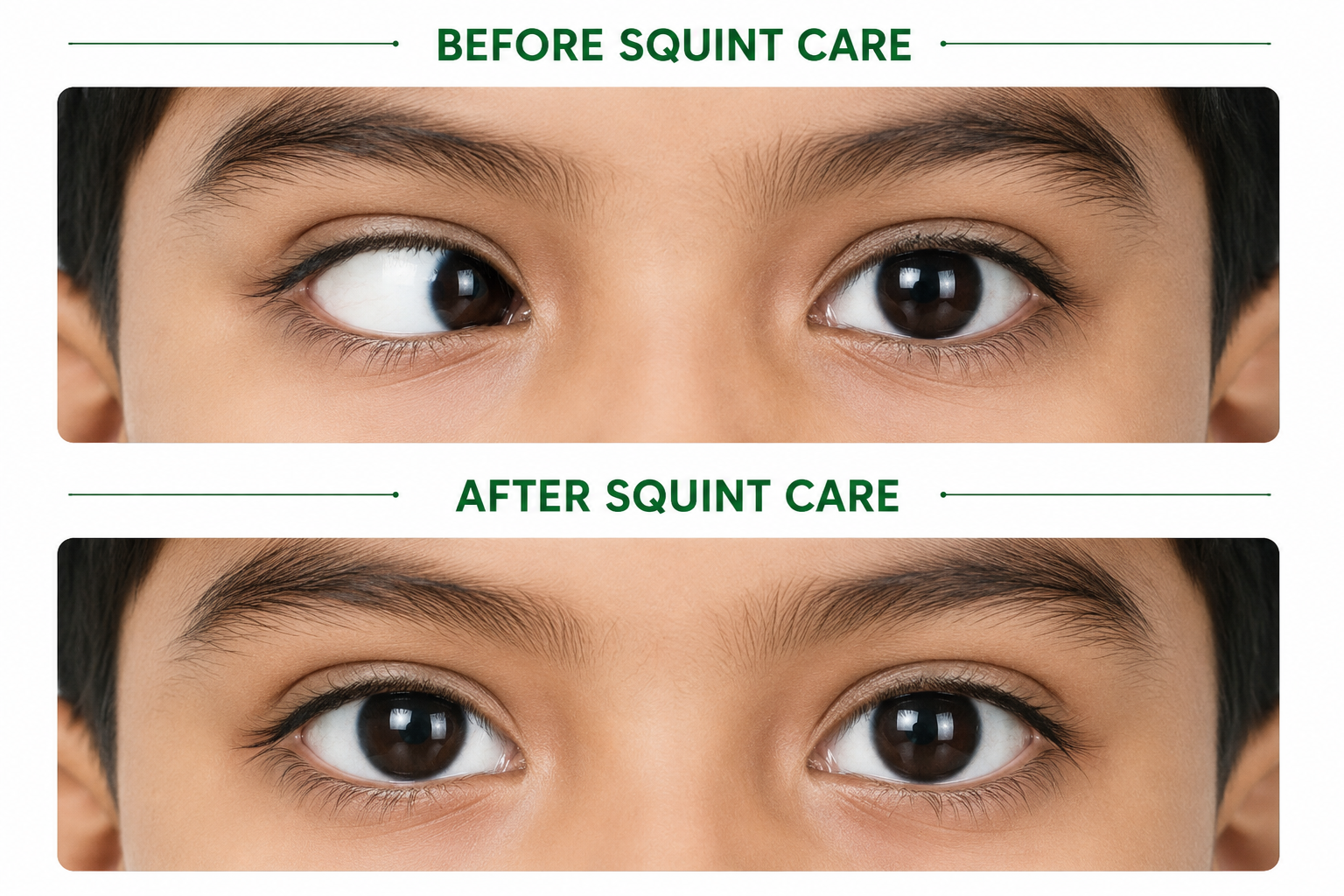 Squint Care