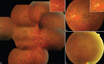 Optic nerve head hypoplasia in a presumed case of retinopathy of prematurity