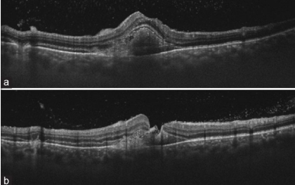 Delayed surgical management for macular hole with submacular hemorrhage