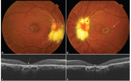Bilateral peripapillary myelinated nerve fiber in a case of Stargardt's phenotype