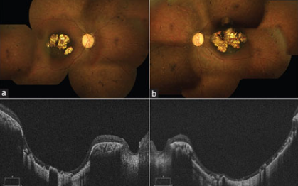 Bilateral macular retinochoroidal excavation in a case of presumed atypical retinitis pigmentosa