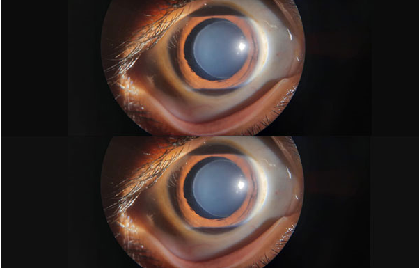 Bilateral Microspherophakia Image 1