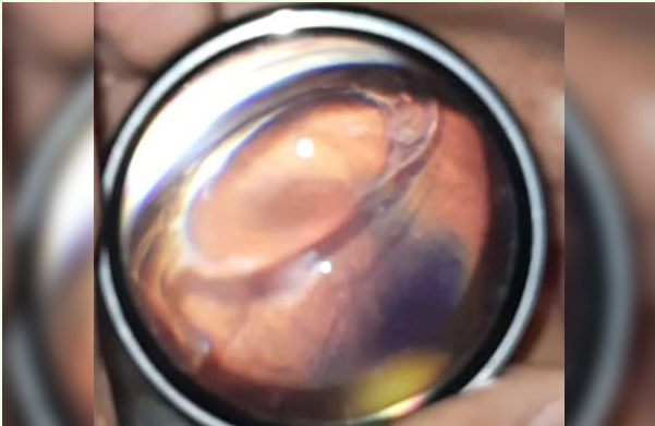 Posteriorly Dislocated Intraocular Lens Image 1