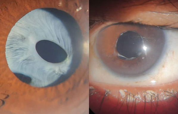 Pre and Post Surgery – Anterior Capsular Phimosis Image 1