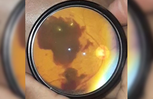 Subhyaloid Hemorrhage in a Diabetic Image 1