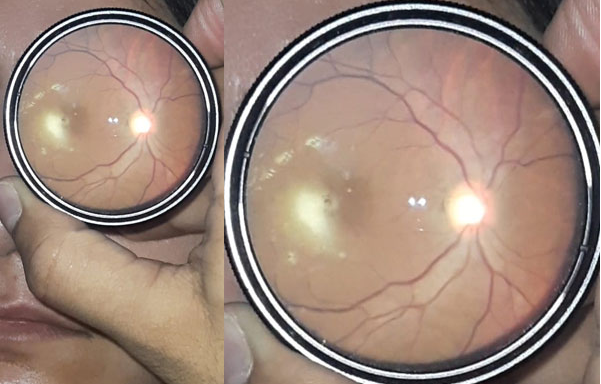 Toxoplasma Retinochoroiditis Image 1