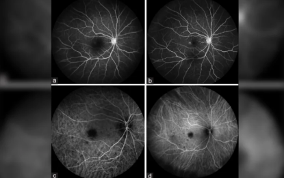 Presumed tubercular choroidal nodule following adalimumab therapy for juvenile idiopathic arthritis