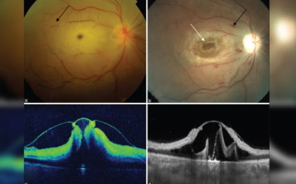 Ischemic macular hole in central retinal artery occlusion