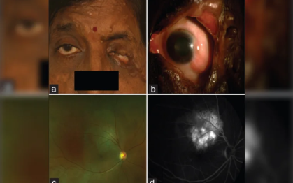 Circumscribed choroidal hemangioma in a case of neurofibromatosis type 1