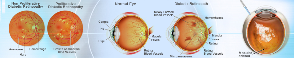 What is Diabetic Retinopathy?