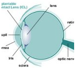 Implantable Contact Lens (ICL)