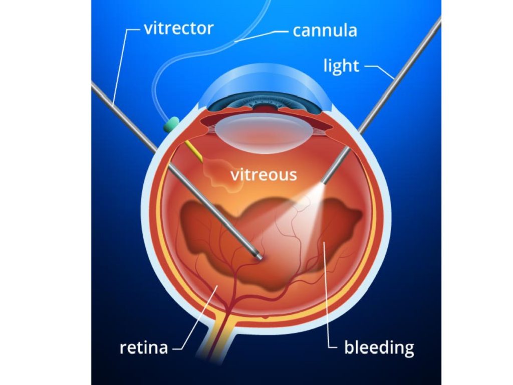 Vitrectomy surgery in Mumbai