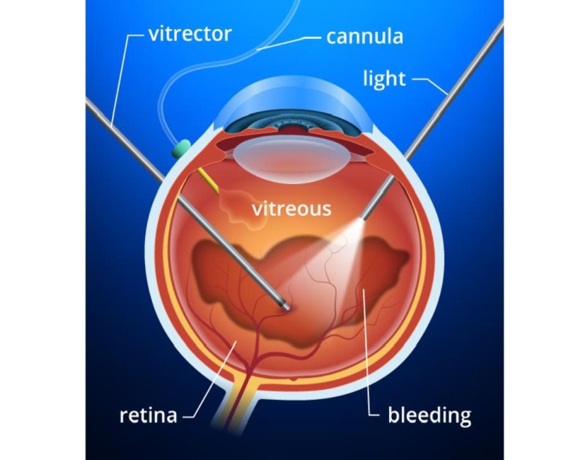 Vitrectomy surgery in Mumbai