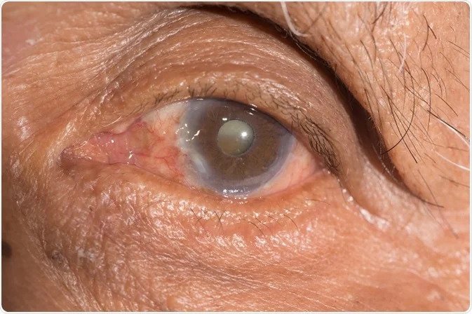 Best Cataract Surgery in Andheri West