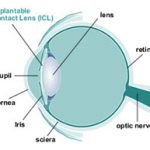 Implantable Contact Lens (ICL)