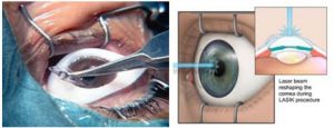 Corrections with Lasik
