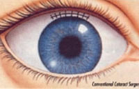 Conventional Technique