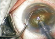 phaco-emulsification