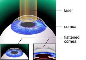 Lasik – Dr Vaidya Eye Hospital