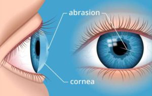 cornea misshapen cornea misshapen