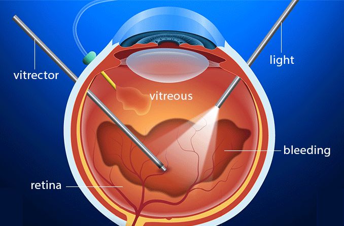 Vitreous Hemorrhage Treatment in Mumbai