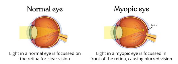 Myopic eye