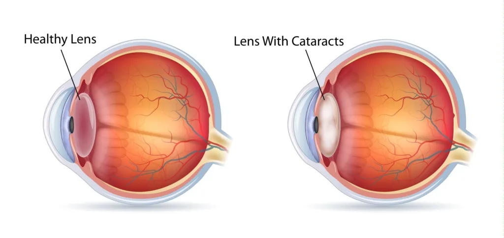 cataract surgery cost