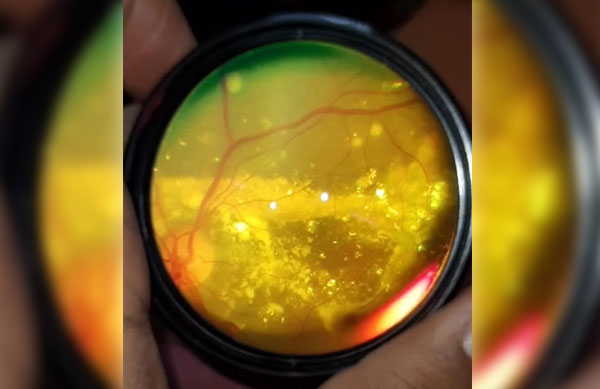 12 year old boy with Coats disease