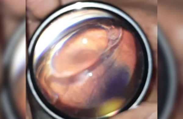 65 year old gentleman with posteriorly dislocated intraocular lens