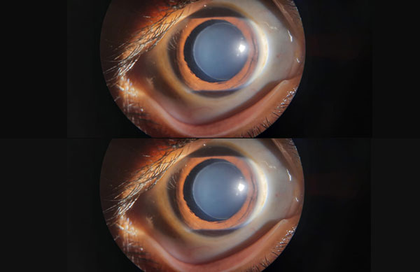 Bilateral Microspherophakia