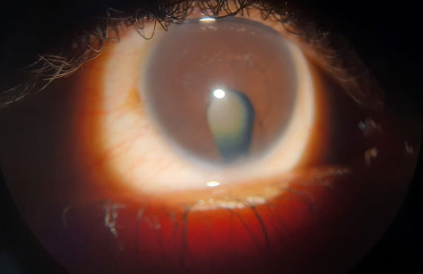 Brunescent Cataract with Iris Coloboma