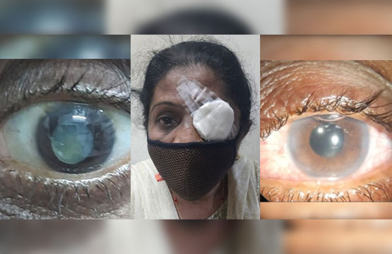 Cataract-Surgery-Triumphs-for-HIV-Positive-Patient's-Left-Eye Cataract Surgery Triumphs for HIV Positive Patients Left Eye