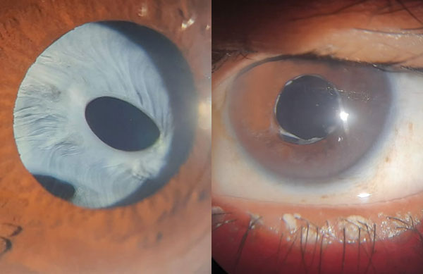 Pre and Post Surgery – Anterior Capsular Phimosis