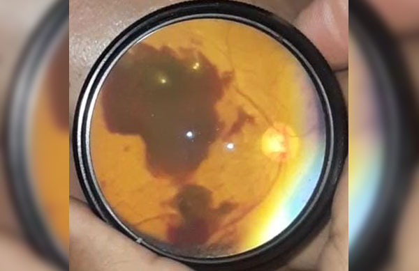 Subhyaloid hemorrhage in a 42 year old Diabetic