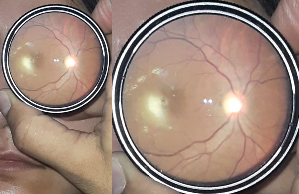 Toxoplasma Retinochoroiditis