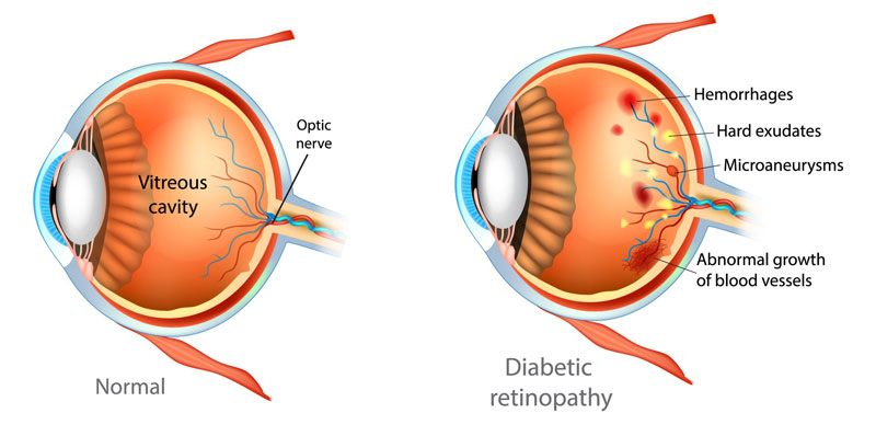 Normal eye and diabetic retinopathy