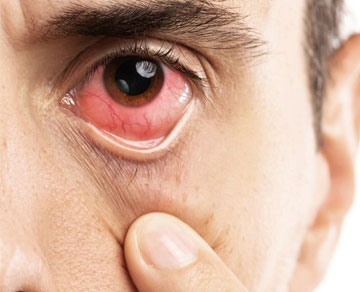 DIABETIC RETINOPATHY