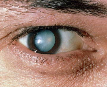 cataract surgery