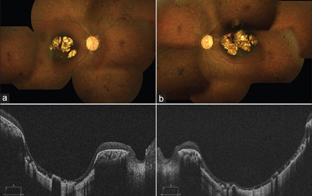 Bilateral-peripapillary-myelinated-nerve Bilateral macular retinochoroidal excavation in a case of presumed atypical retinitis pigmentosa
