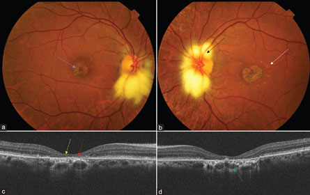 Bilateral-peripapillary-myelinated-nerve Bilateral peripapillary myelinated nerve