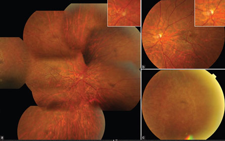 Optic-nerve-head-hypoplasia Optic nerve head hypoplasia in a presumed case of retinopathy of prematurity
