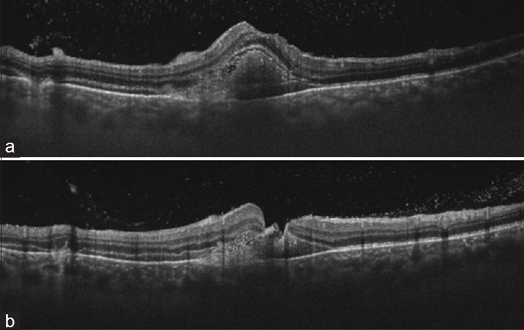 optical-coherence-tomography Delayed surgical management for macular hole with submacular hemorrhage