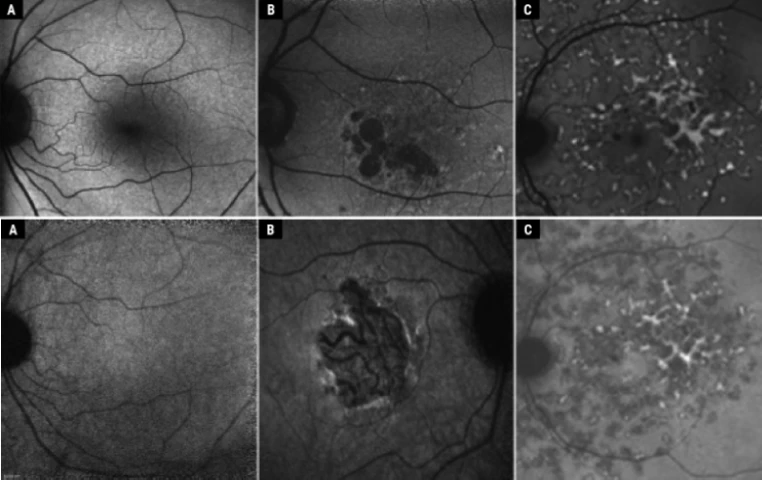 An Update on Fundus Autofluorescence An Update on Fundus Autofluorescence